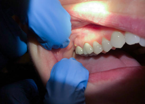 Best Emergency Broken Tooth Repair in Passapatanzy, VA