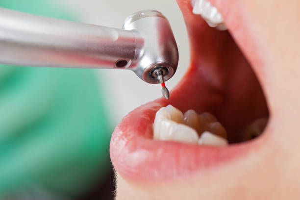 Best Emergency Tooth Extraction in Passapatanzy, VA